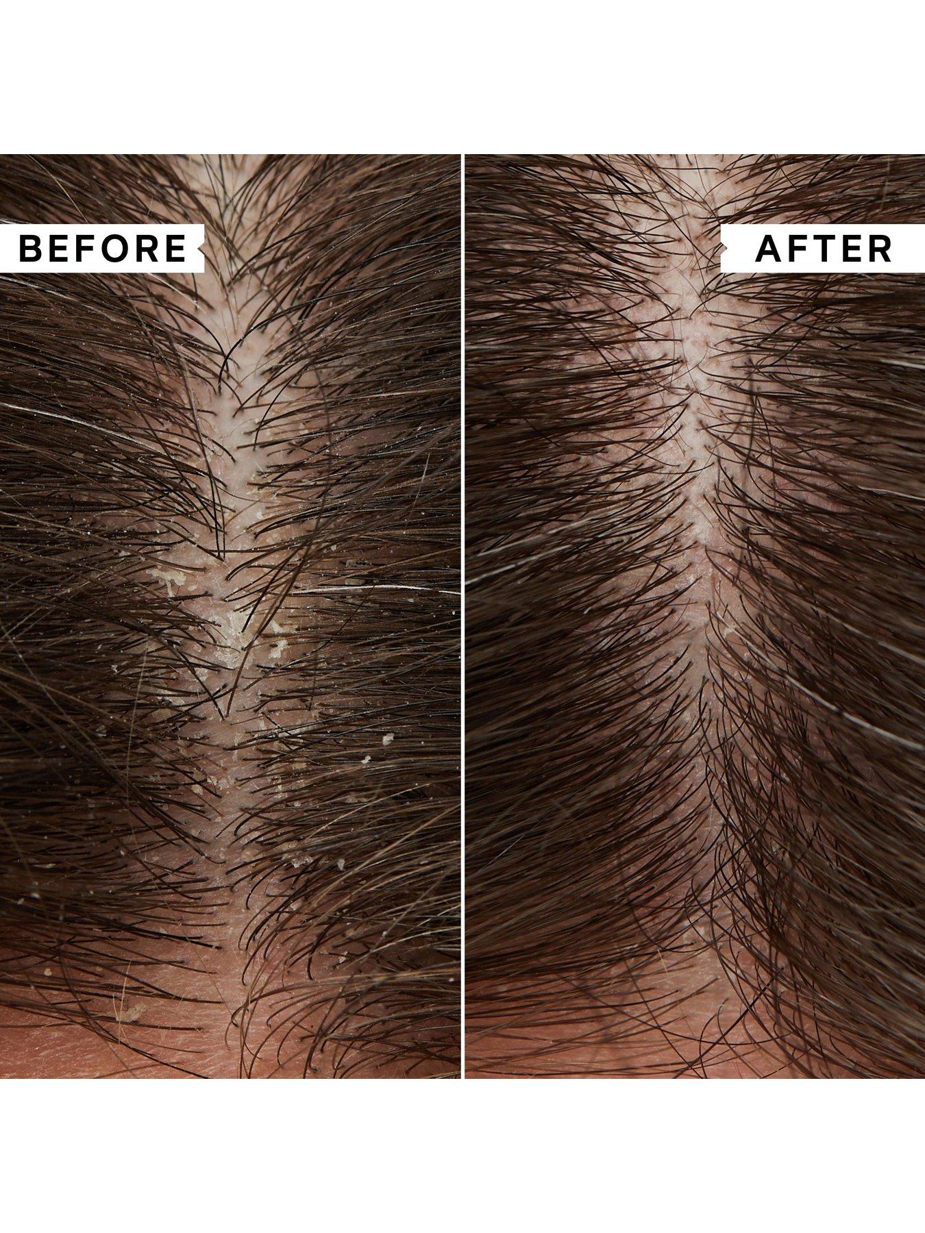 Image 4 of 6 of Philip Kingsley Flaky/Itchy Scalp Anti-Dandruff Shampoo 1000ml