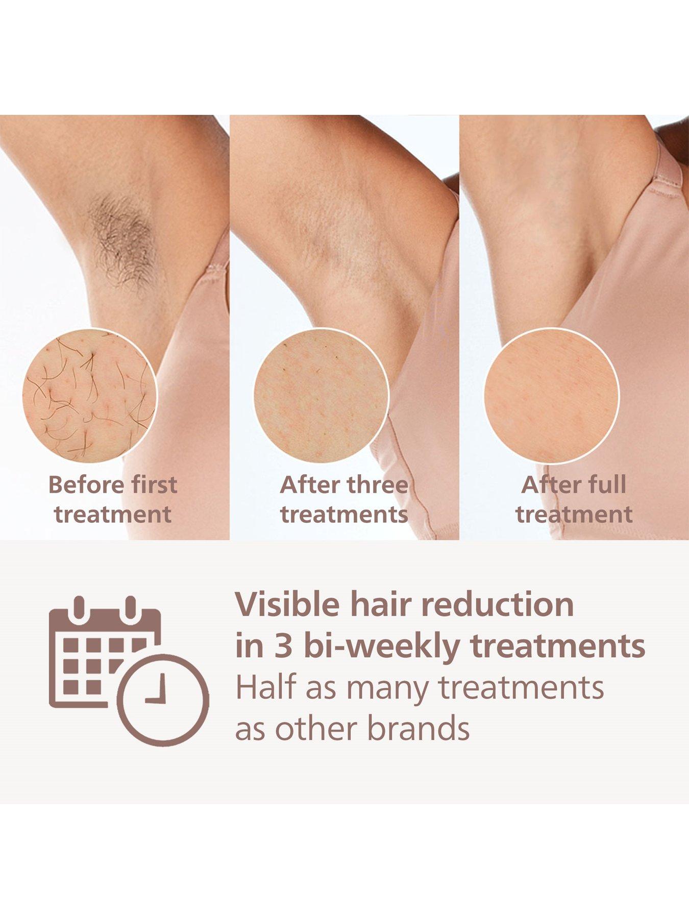 Image 3 of 8 of Philips Philips Lumea 9000 Series, IPL Hair Removal Device, 3 Attachments for Body, Face and Precision Areas, Corded and Cordless Use, BRI955/01