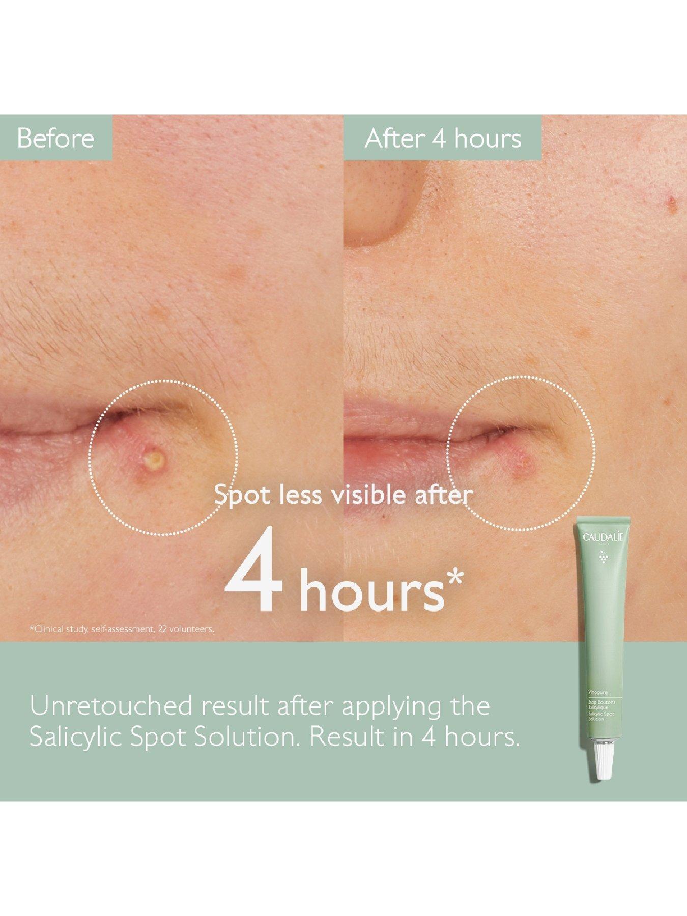 caudalie-vinopure-salicylic-spot-solution-15mlstillFront