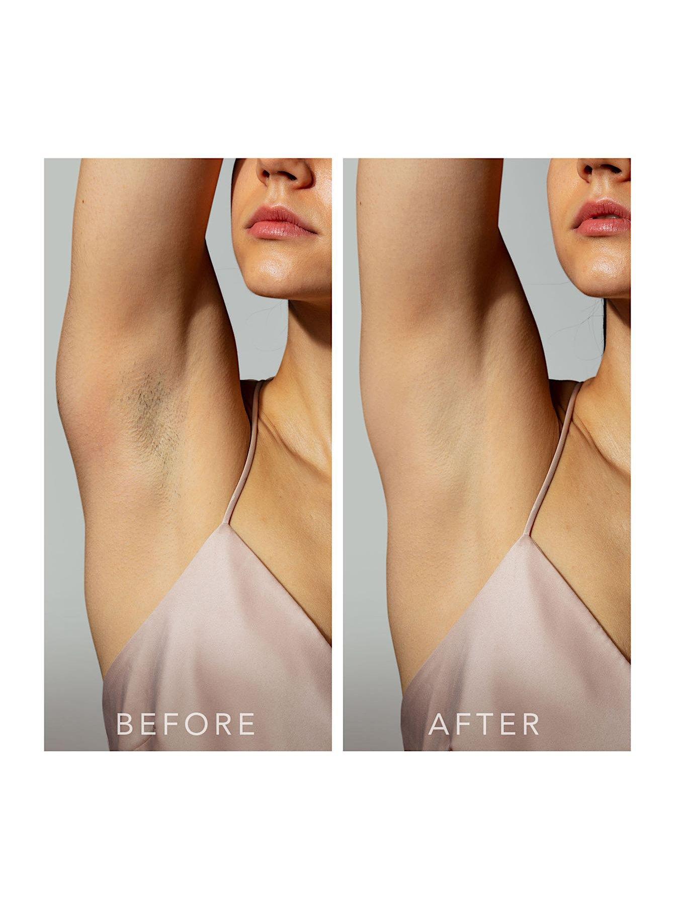 Image 5 of 7 of FOREO FOREO PEACH 2, IPL Hair Removal Device