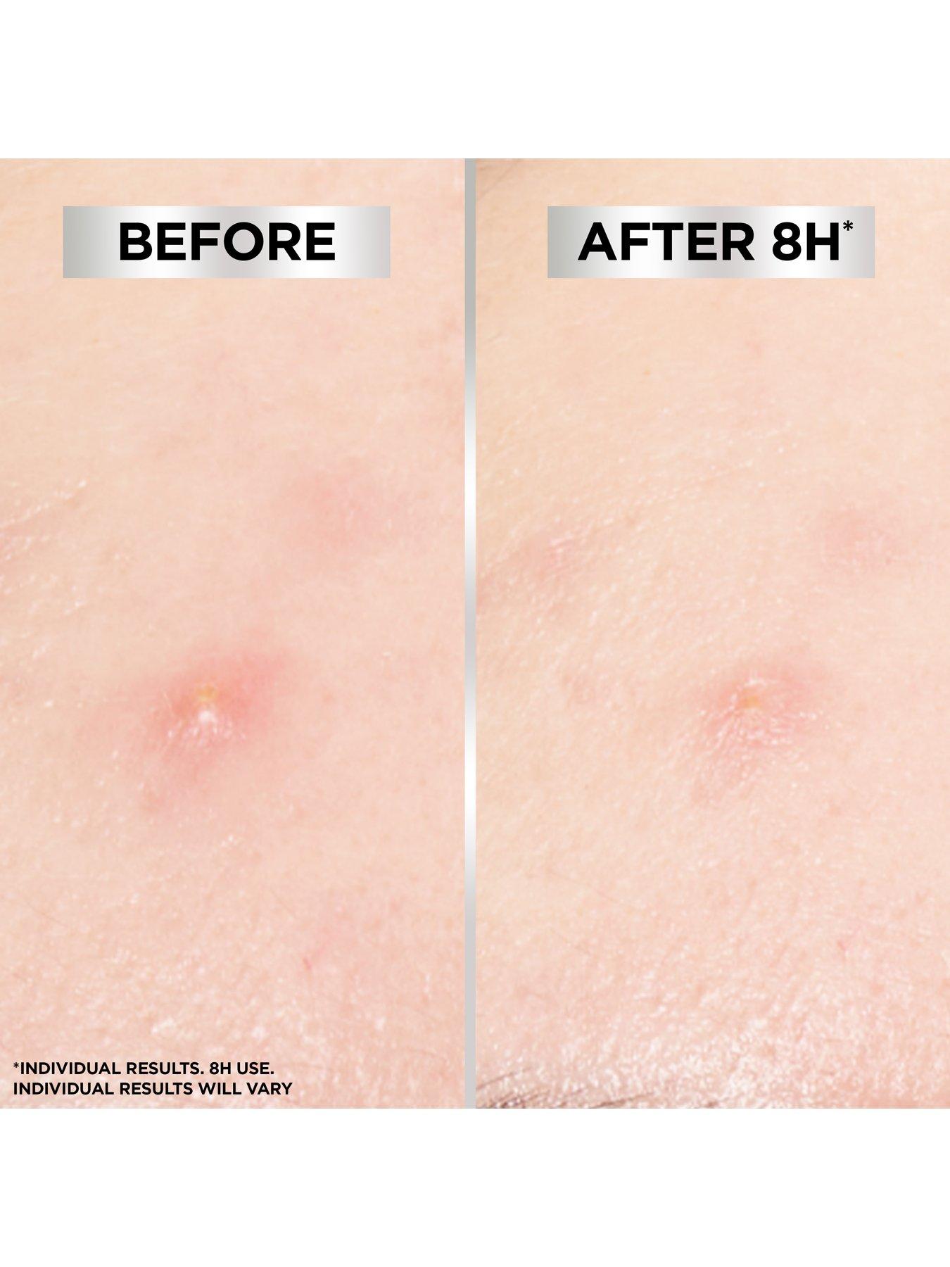 garnier-8h-invisible-blemish-patches-44-patchesdetail