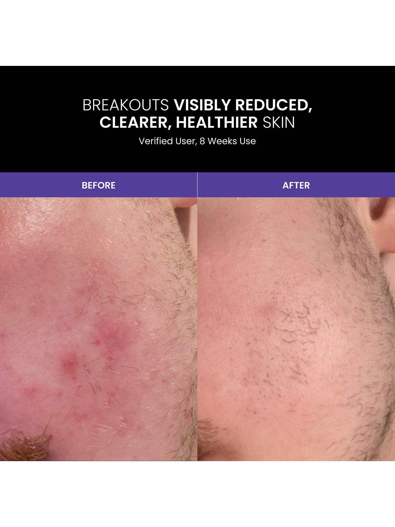 Image 7 of 8 of Lustre Renew Pro LED Face Mask