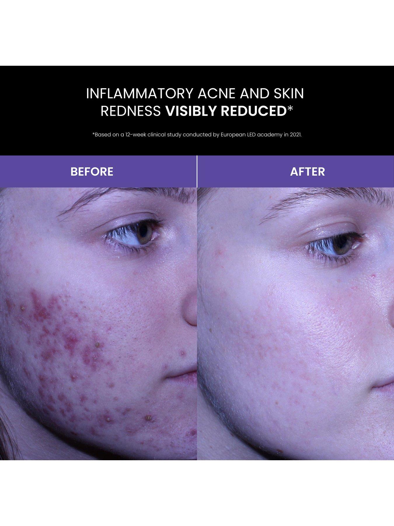 Image 7 of 8 of Lustre Solo LED Acne Pod